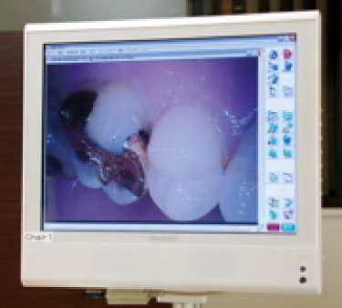 口腔内カメラモニター