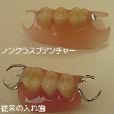 ノンクラスプデンチャー