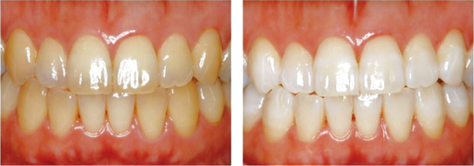 ホワイトニング ビフォー&アフター