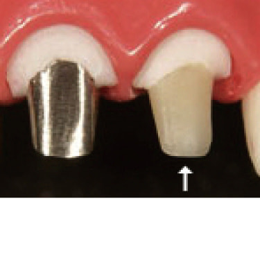 ファイバーコア