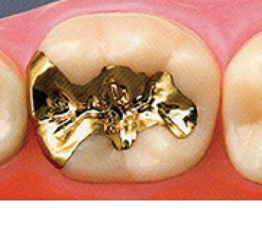 ゴールドインレー