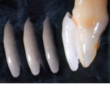 ラミネートベニア