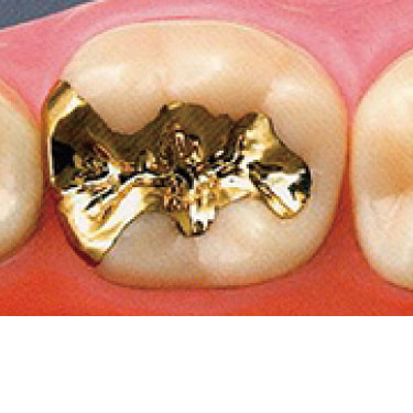 ゴールドインレー